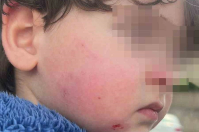 Kreşe bıraktığı çocuğunu darp edilmiş halde aldı